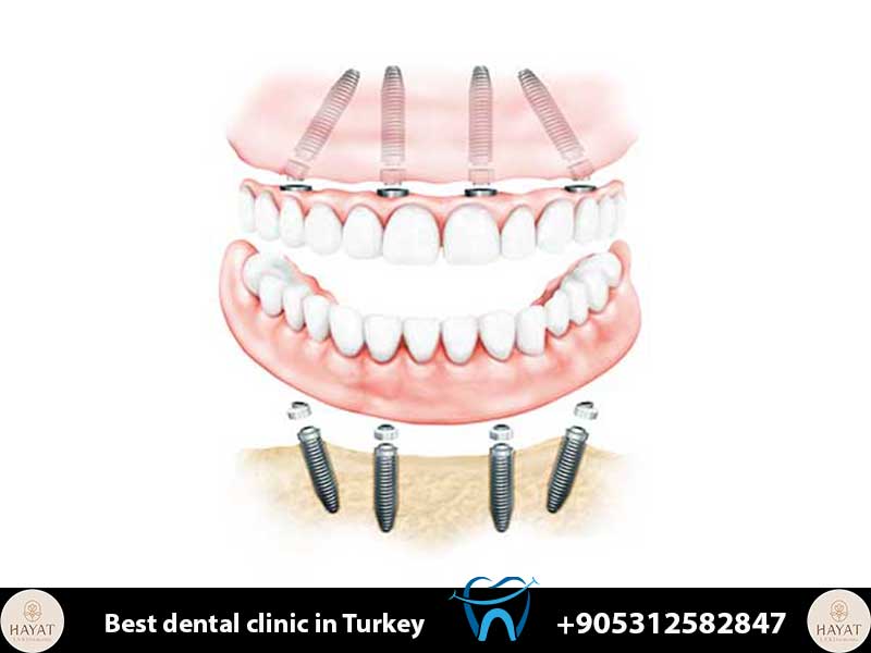 all on 4 dental implants