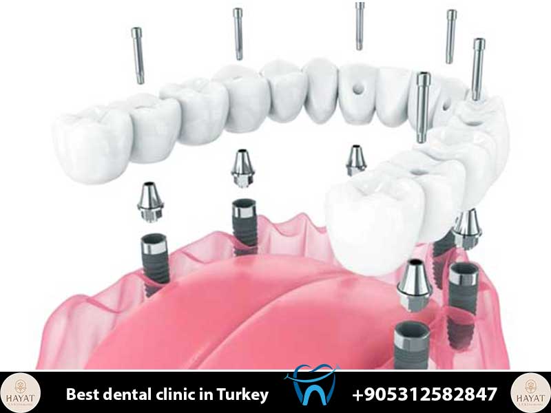 all on 6 dental implants