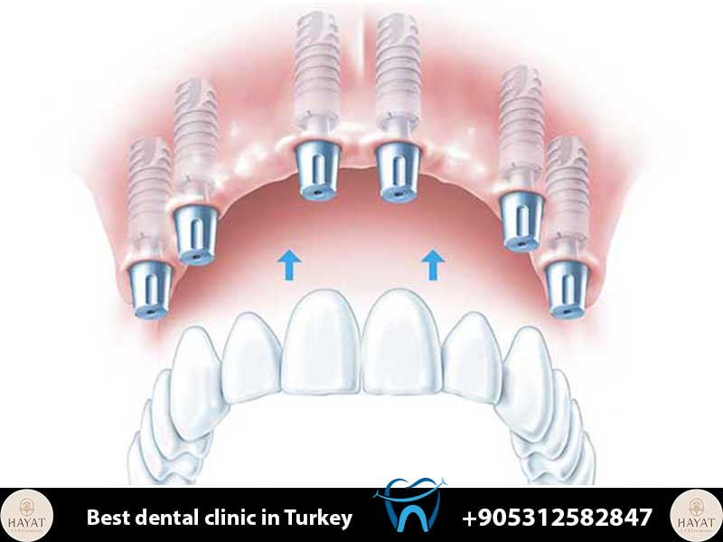 all on 8 dental implants