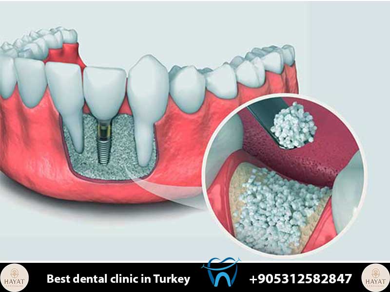bone grafting and sinus lift