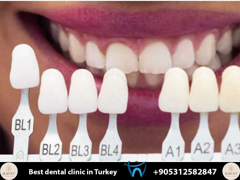 choosing the perfect teeth shade for your skin