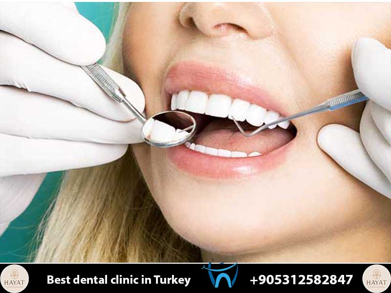 composite bonding
