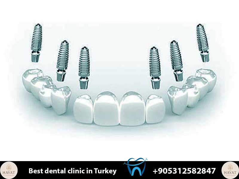 dental implant healing stages day by day