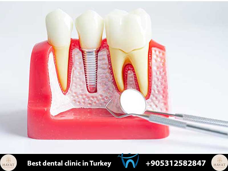 Dental Implants Turkey vs UK Price List 2026: The Ultimate Cost & Quality Comparison dental implants turkey vs uk price list 2026