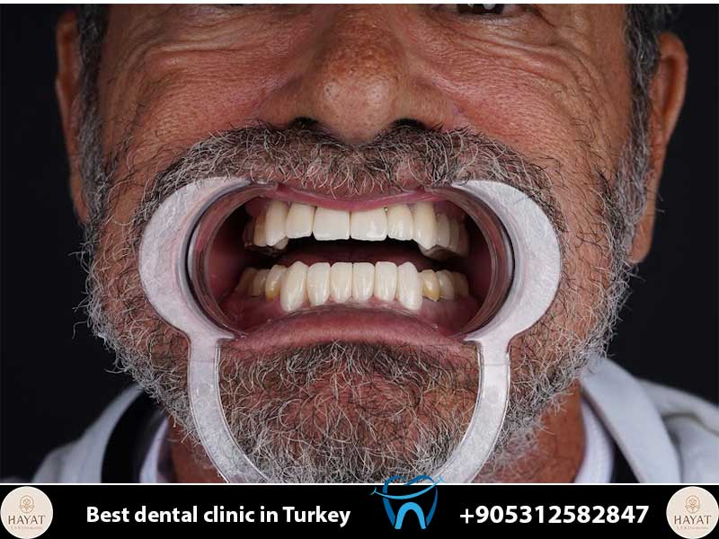 Full Arch Dental Implants in Turkey: Restore Your Smile with World-Class Expertise dental implants