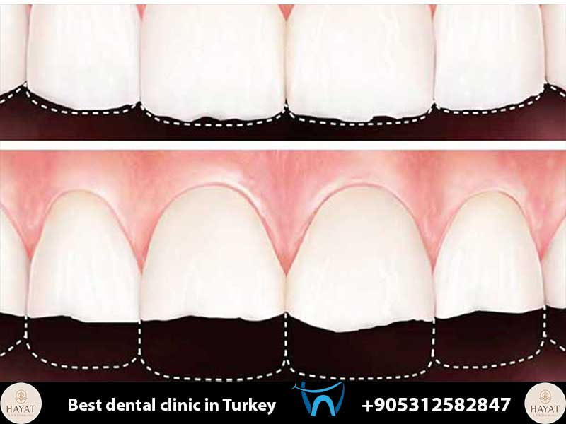 does veneers procedure damage natural teeth