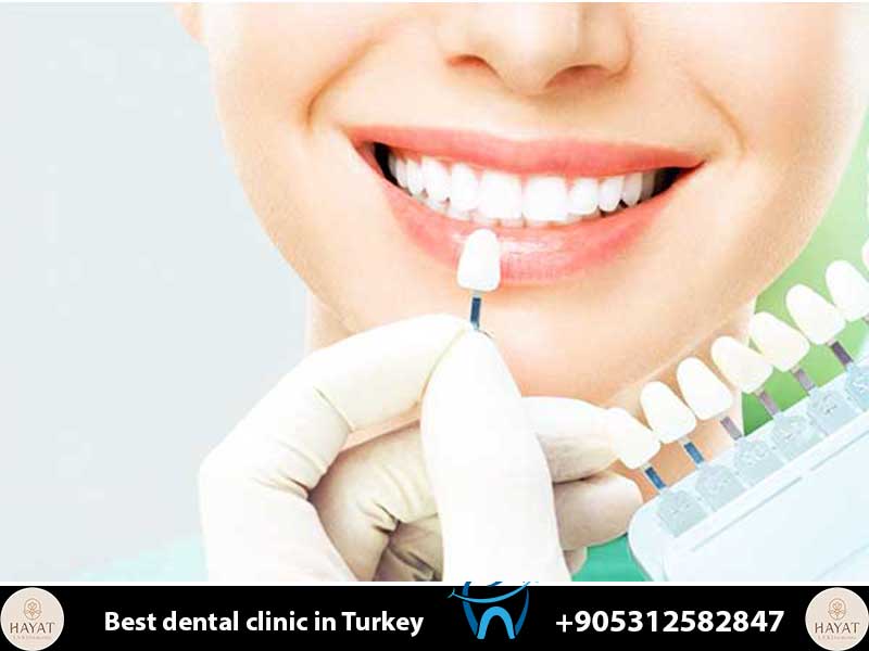 emax veneers
