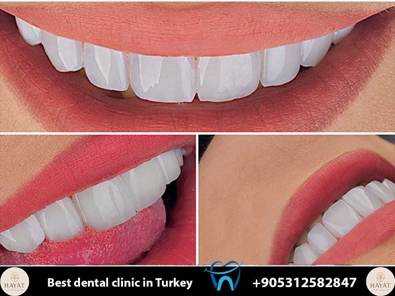 The Science of Hollywood Smile | Digital Smile Design & Veneers hollywood smile