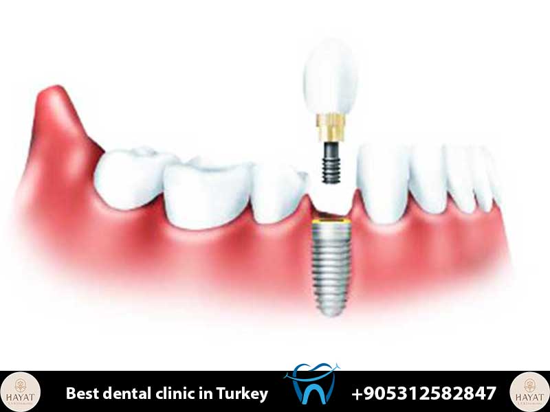 immediate load implants