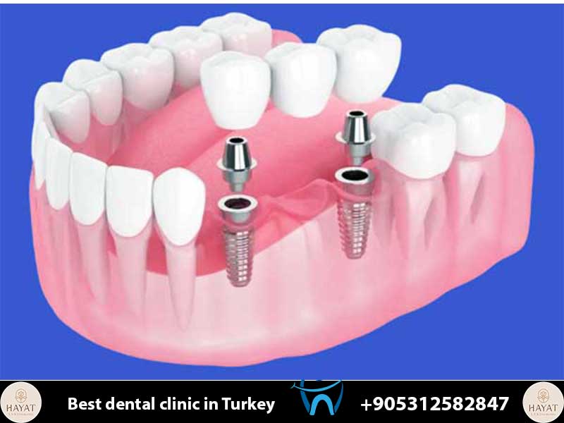 Implant Price Guide 2026: Everything You Need to Know About Dental Costs implant price guide 2026