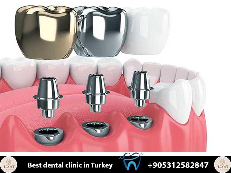 is dental implant surgery safe in turkey