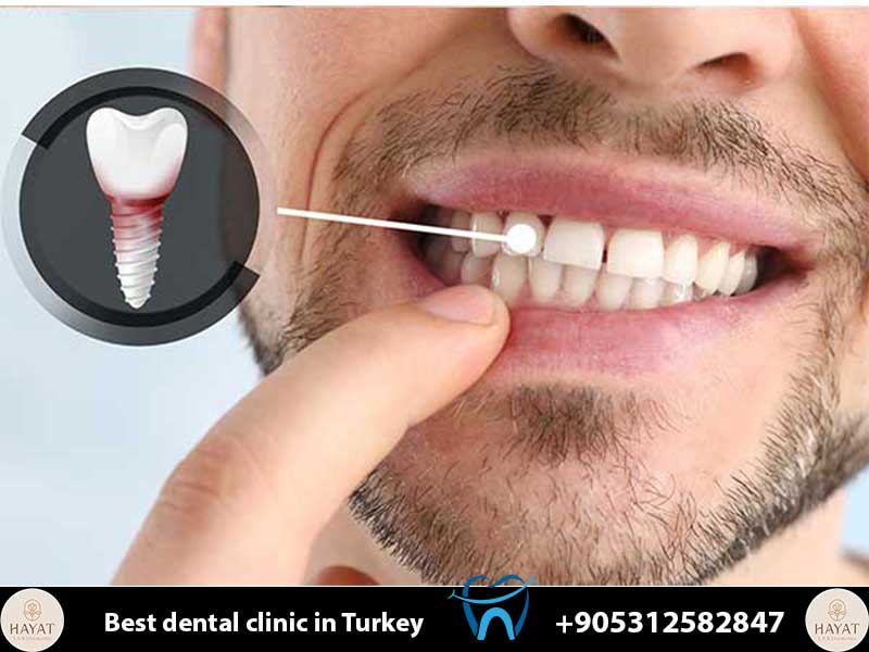 nobel biocare implants