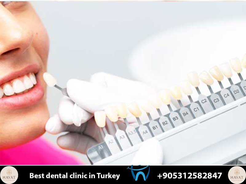 porcelain veneers