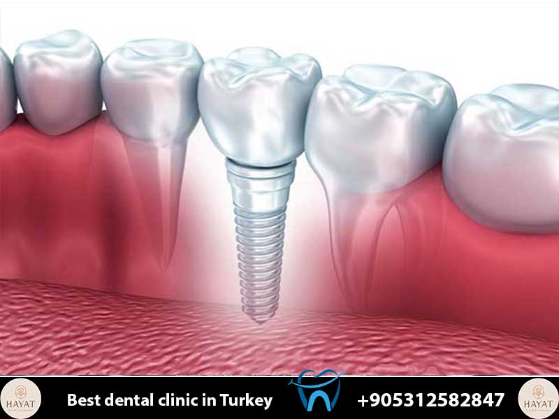 single tooth implant