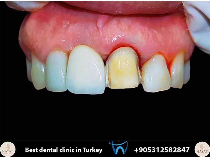 teeth shaving for veneers facts vs myths
