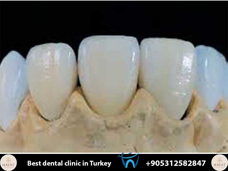 zirconium crowns vs emax veneers which is best