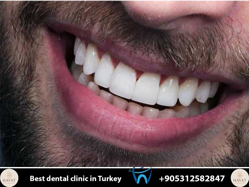 zirconium crowns
