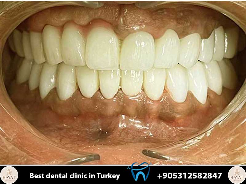 zygomatic implants