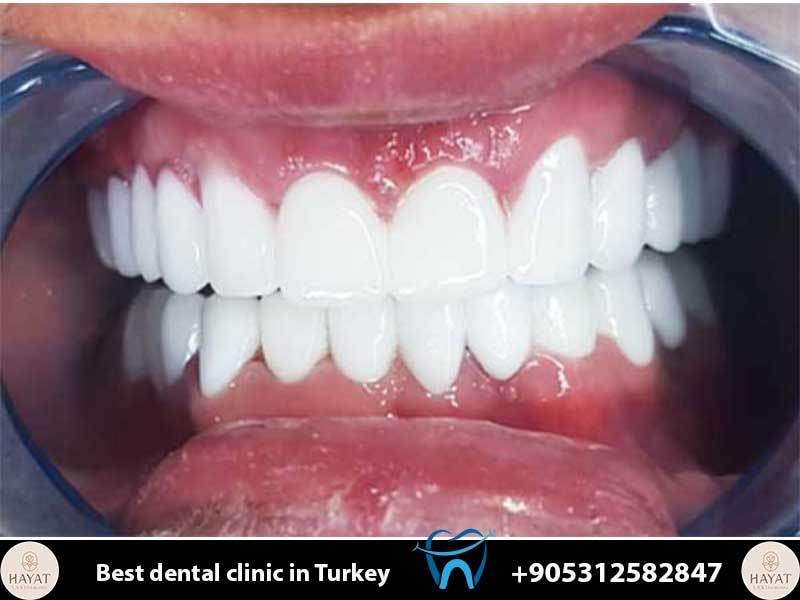 can dental implants be done with bone loss