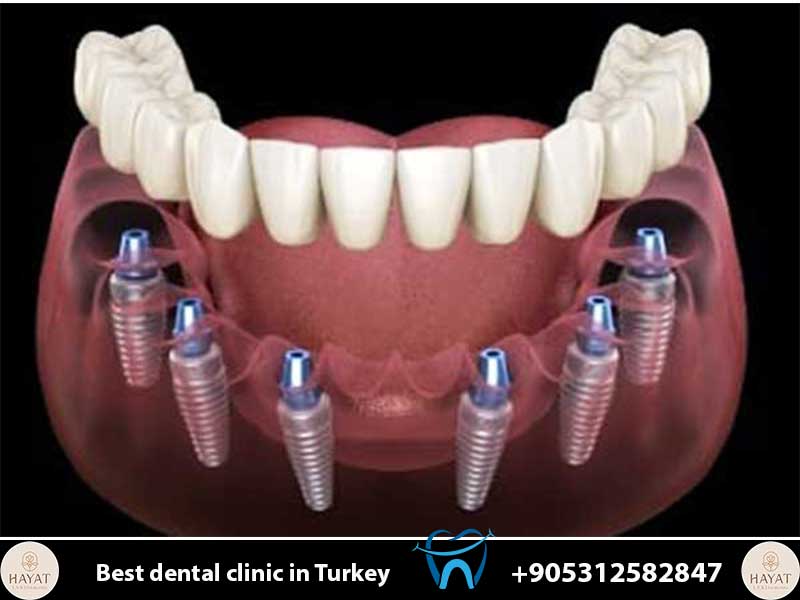 pain management after implant surgery