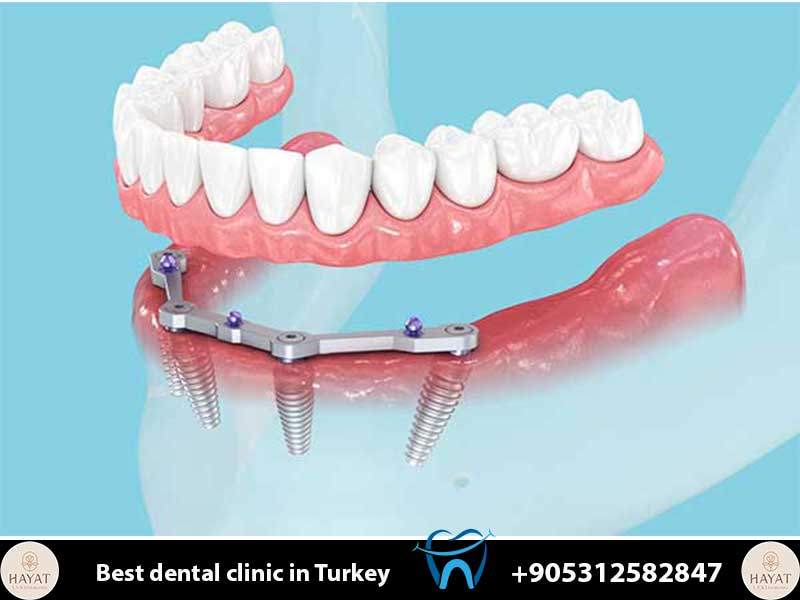 signs of dental implant failure prevention