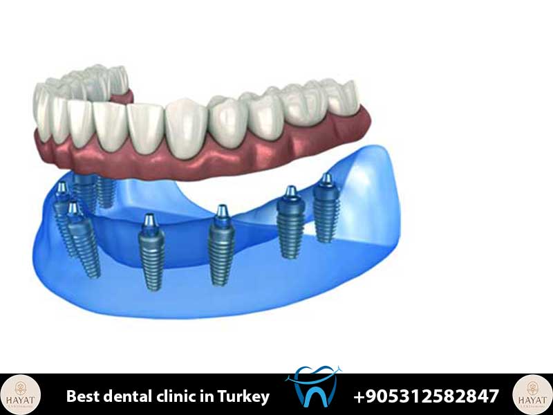 titanium vs zirconia implants comparison